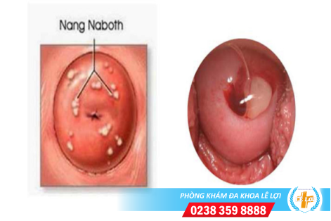 Nang naboth là bị bệnh gì?