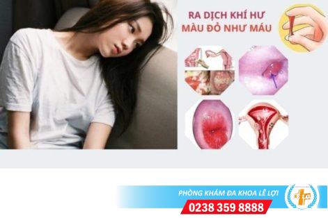 Ra dịch khí hư màu đỏ như máu nguyên nhân và cách điều trị