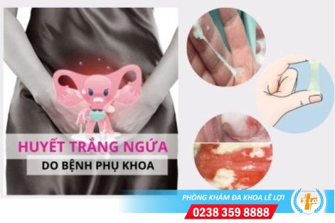 Huyết trắng ngứa là bị gì?