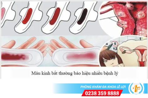 Nhận biết tình trạng sức khỏe qua màu sắc kinh nguyệt