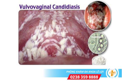 Nấm Candida là gì? Dấu hiệu để nhận biết