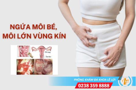 Ngứa môi bé, môi lớn vùng kín là bị gì?