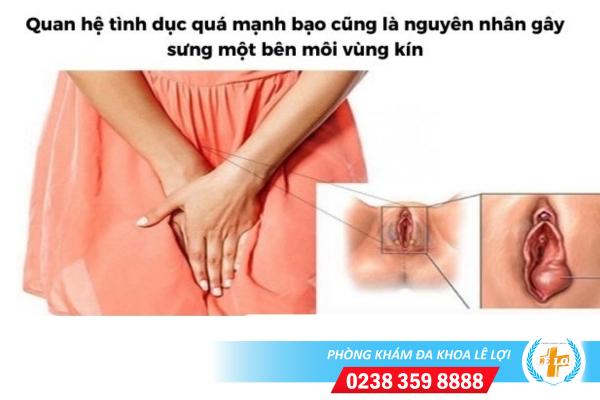 Nguyên nhân sưng 1 bên môi vùng kín