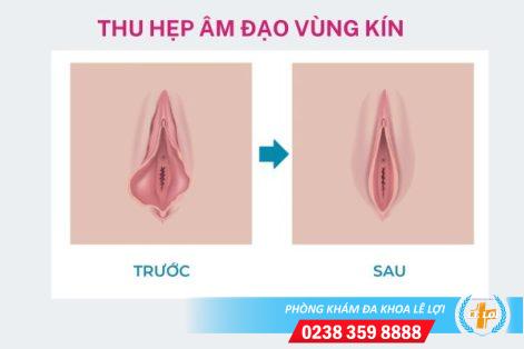 Thế nào là phương pháp thu hẹp âm đạo vùng kín?