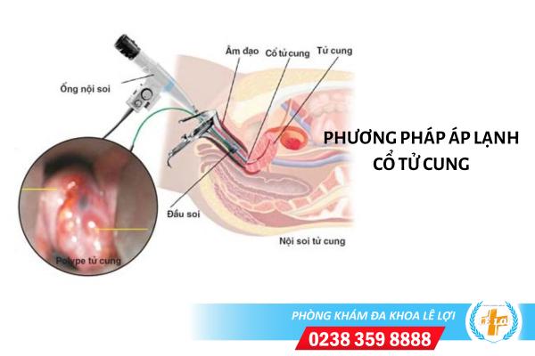 Những điều cần biết về áp lạnh cổ tử cung