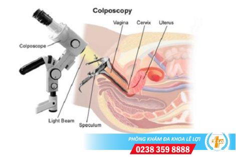 Đốt polyp cổ tử cung có đau không chi phí bao nhiêu?