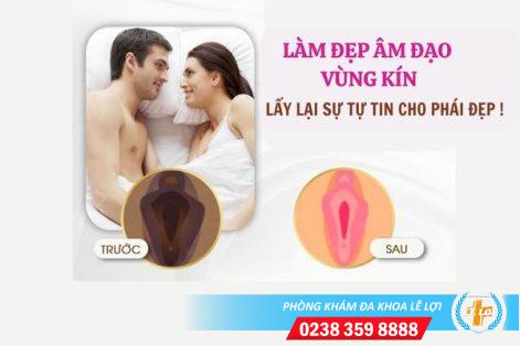 Phương pháp làm đẹp âm đạo vùng kín hiệu quả an toàn