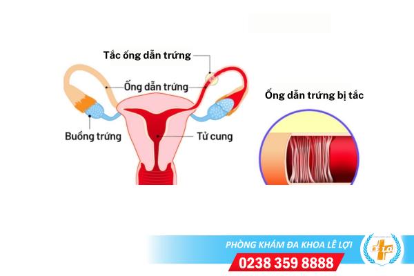 Dấu hiệu tắc ống dẫn trứng và cách điều trị