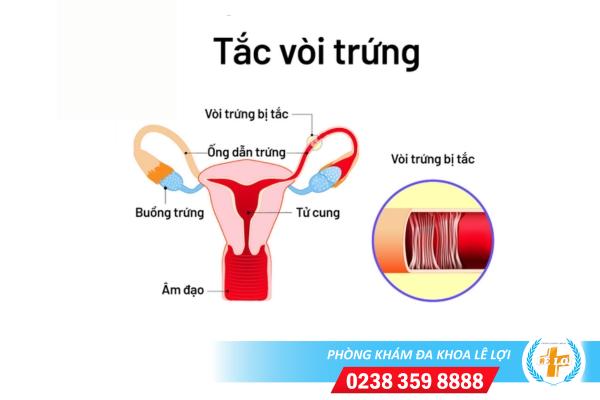 Phương pháp điều trị tắc vòi trứng hiệu quả