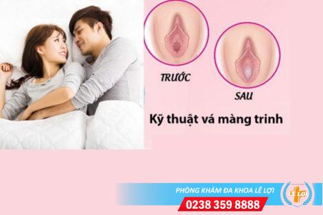 Tìm hiểu về thủ thuật vá màng trinh