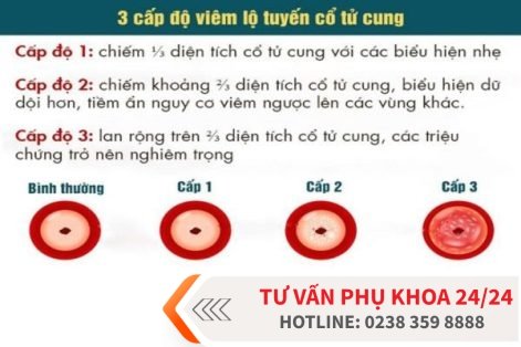 Những thông tin cần biết về bệnh viêm lộ tuyến cổ tử cung