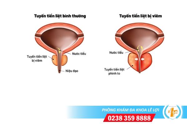 Dấu hiệu nhận biết viêm tuyến tiền liệt nữ